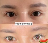 双眼皮修复吴焱秋、韩勋和杜园园哪个好？