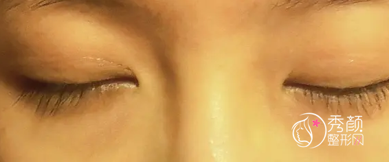 北京姜洪涛双眼皮修复怎么样,有没有失败案例?