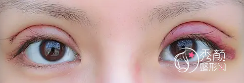 北京姜洪涛双眼皮修复怎么样,有没有失败案例？