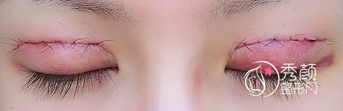 北京姜洪涛双眼皮修复怎么样,有没有失败案例？