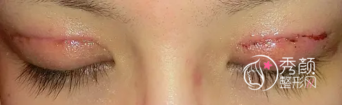 北京姜洪涛双眼皮修复怎么样,有没有失败案例？