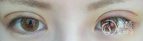 北京姜洪涛双眼皮修复怎么样,有没有失败案例？