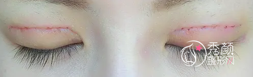 北京姜洪涛双眼皮修复怎么样,有没有失败案例？