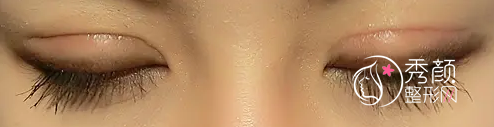 北京姜洪涛双眼皮修复怎么样,有没有失败案例？