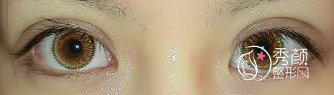 北京姜洪涛双眼皮修复怎么样,有没有失败案例？