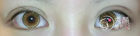 北京姜洪涛双眼皮修复怎么样,有没有失败案例？