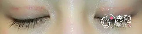 北京姜洪涛双眼皮修复怎么样,有没有失败案例？