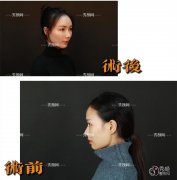 成都华美董玉林医生隆鼻怎么样