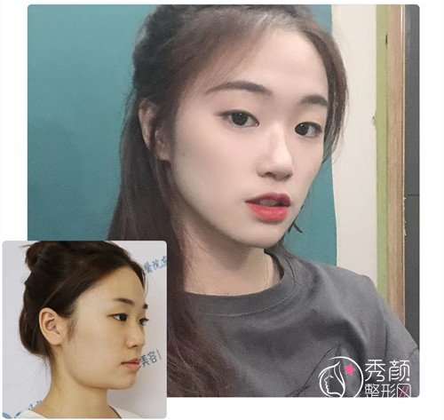 成都颧骨内推下颌角截骨李运峰和张立天哪个医生比较好