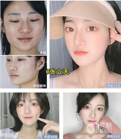 成都颧骨内推下颌角截骨李运峰和张立天哪个医生比较好