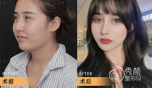 北京刘彦军隆鼻怎么样？