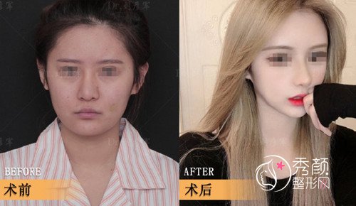 北京刘彦军隆鼻怎么样？