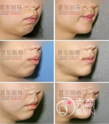 <b>上海首尔丽格朴兴植和北京联合丽格柳春明正颌手术哪个做的好？</b>