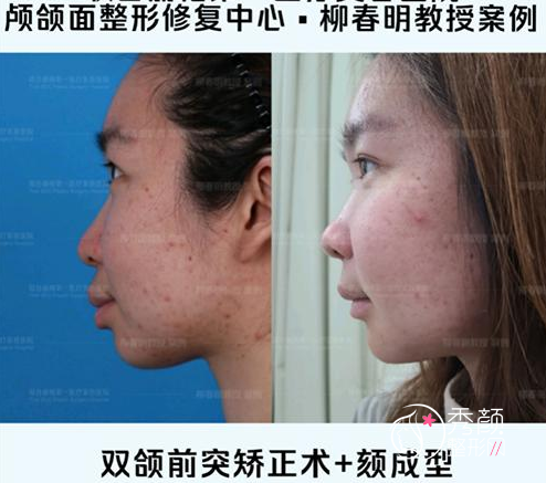上海首尔丽格朴兴植和北京联合丽格柳春明正颌手术哪个做的好？