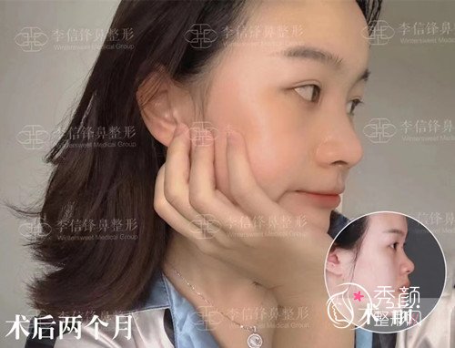 深圳李信锋做鼻子怎么样，有没有失败案例？