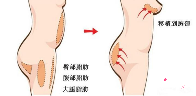 上海九院自体脂肪隆胸多少钱？