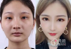 郑州磨骨李钢和赵绛波谁做下颌角颧骨内推比较好？