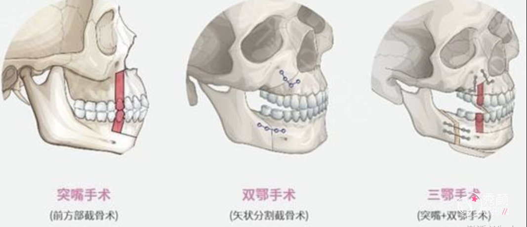 上海首尔丽格正颌手术怎么样,哪个医生做的好？