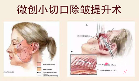 上海九院做小切口除皱多少钱，贵不贵？