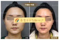 黄大勇做下颌角有失败的吗？