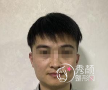 花了40000找郑州李钢做的下颌角磨骨你们看值不值！
