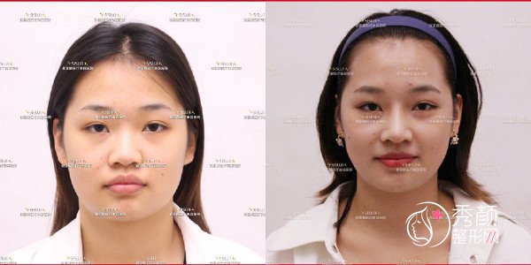 北京联合丽格宫风勇医生做鼻子好吗，附隆鼻案例前后对比