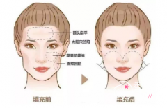 八大处谁做自体脂肪填充好,唐勇脂肪填充怎么样？