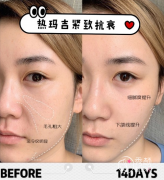 <b>热玛吉和拉皮做哪个比较好</b>