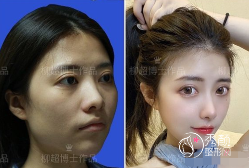 磨骨手术做的好吗，有没有什么黑料？