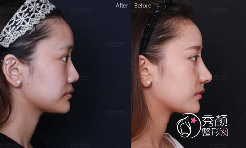 北京较好的做鼻修复专家是谁，刘彦军做鼻修复咋样？