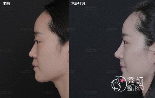 北京较好的做鼻修复专家是谁，刘彦军做鼻修复咋样？
