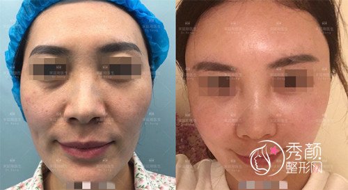 北京宋延刚脂肪填充怎么样,有没有失败案例？