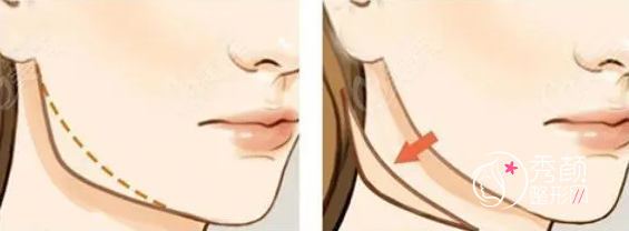 上海伊莱美、首尔丽格、华美、时光哪个做磨骨手术好？