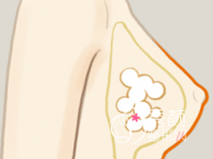 <b>自体脂肪隆胸术后多久能恢复自然，手感不错？</b>