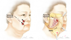 北京华韩柳民熙拉皮手术做的好吗