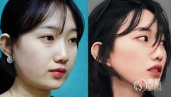 <b>下颌角磨骨手术后一定会下垂吗？修复难度大吗？</b>