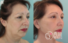 <b>面部拉皮除皱术果怎么样？有什么副作用？</b>