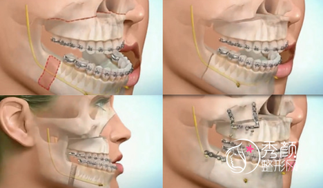 国内正颌哪家医院好，整理几家国内可以做正颌手术的医院医生。