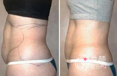 <b>全身吸脂分为哪些部位，大概需要多少钱？</b>