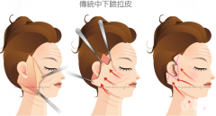 <b>拉皮手术除皱果好吗，有没有副作用？</b>