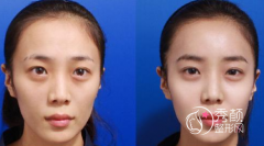 北京自体脂肪填充哪个医生好，北京脂肪填充医生测评。