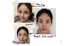 <b>下颌角磨骨手术风险大吗？磨骨手术住院几天？</b>