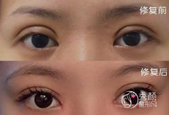 <b>双眼皮修复难度高吗，风险大不大？修复贵不贵？</b>