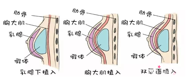 武汉隆胸哪个医生好,武汉隆胸医生测评。