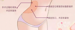 <b>腰腹环吸后多久可以怀孕？腰腹吸脂术后注意事项。</b>