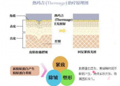 深圳联合丽格王洪军热玛吉除皱果怎么样？