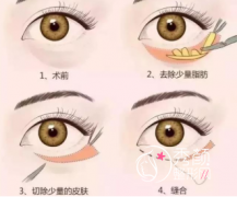 沈阳百嘉丽去眼袋多少钱？