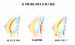 <b>成都假体隆胸多少钱？</b>