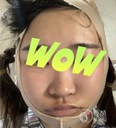 四川友谊罗恩做颧骨内推怎么样，我们一起来看看案例。