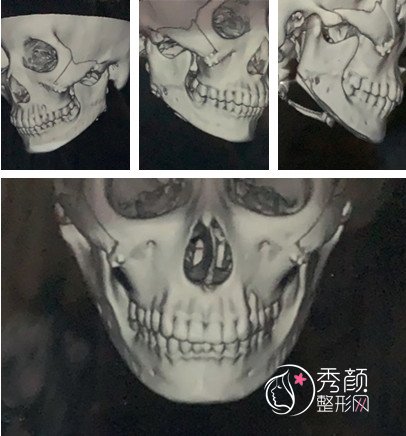 四川友谊罗恩做颧骨内推怎么样，我们一起来看看案例。